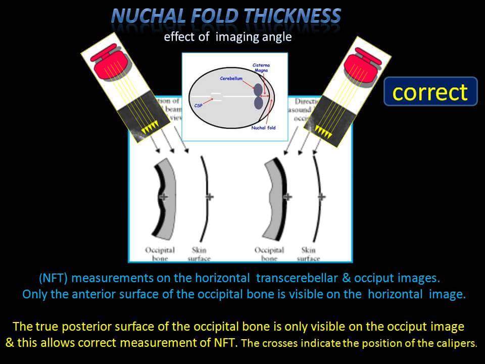Nuchal Fold Thickness