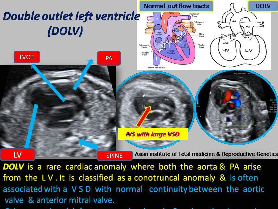 Double Outlet Left Ventricle