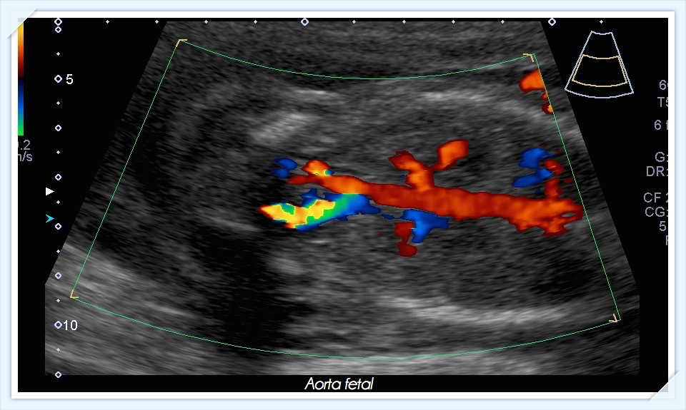 Aorta Fetal