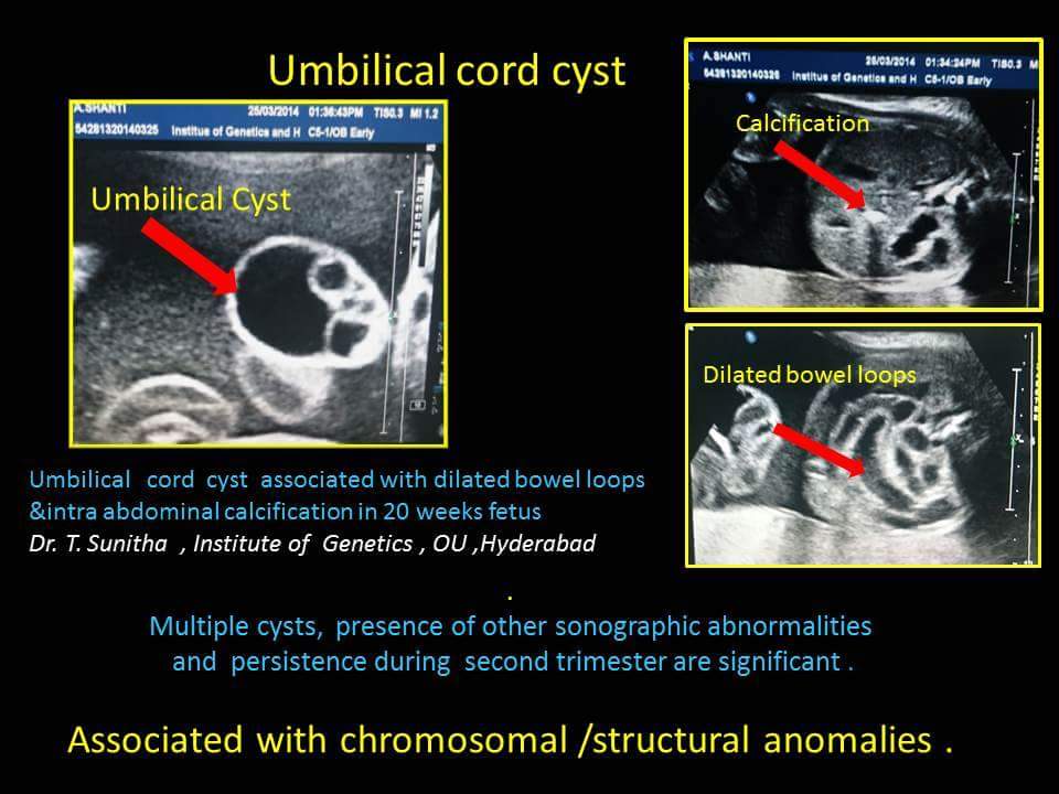 Umbilical Cord Cyst