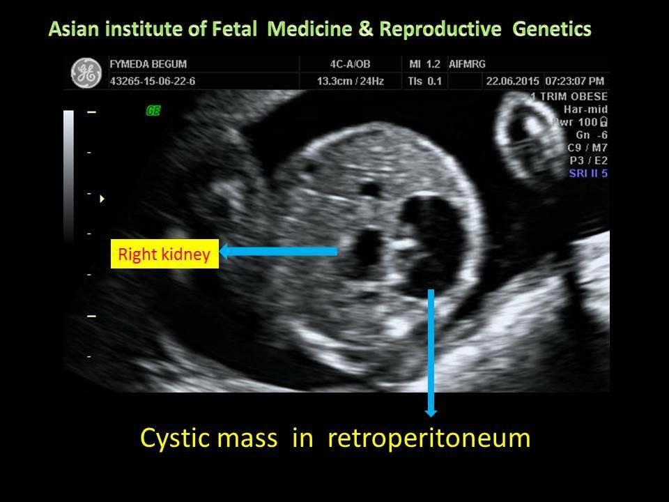 Cystic Mass in Retroperitoneum