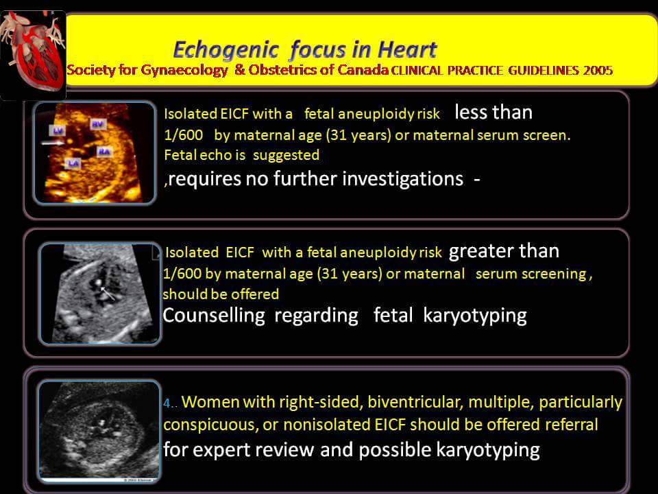 Echogenic Focus in Heart