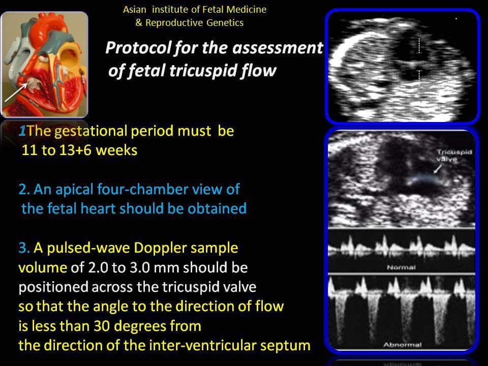 Protocol for the assessment of fetal tricuspid flow