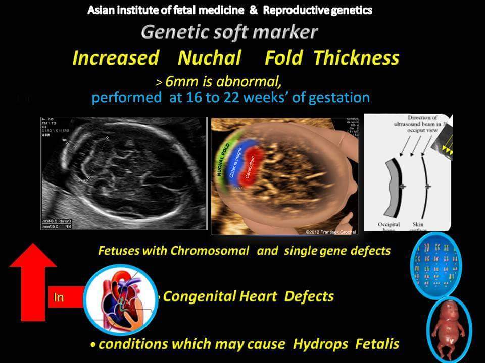 Increased Nuchal Fold Thickness