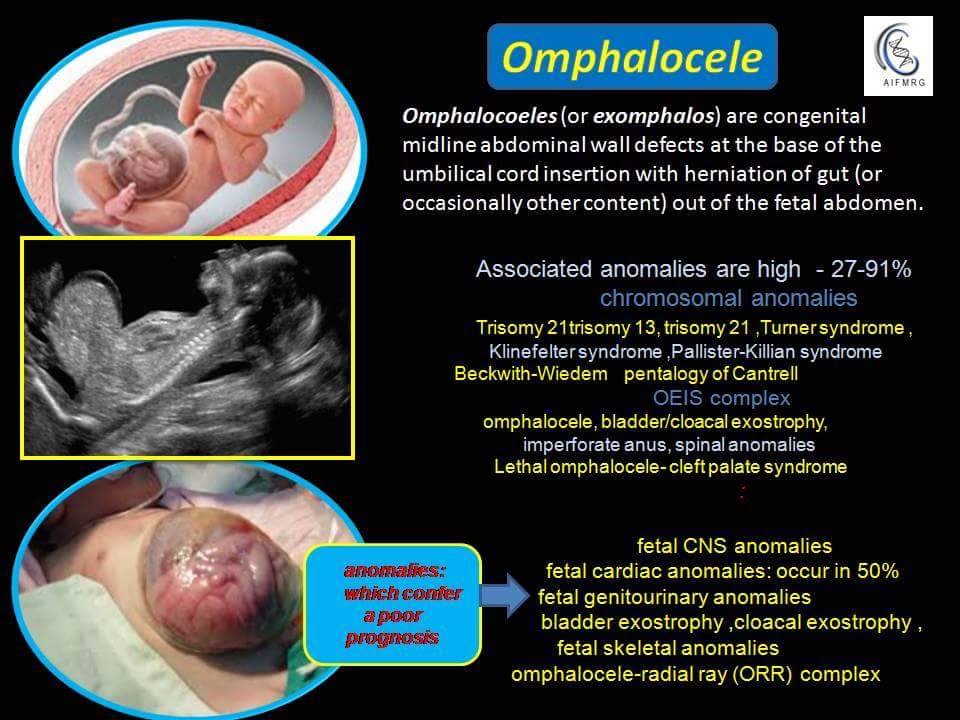Omphalocele