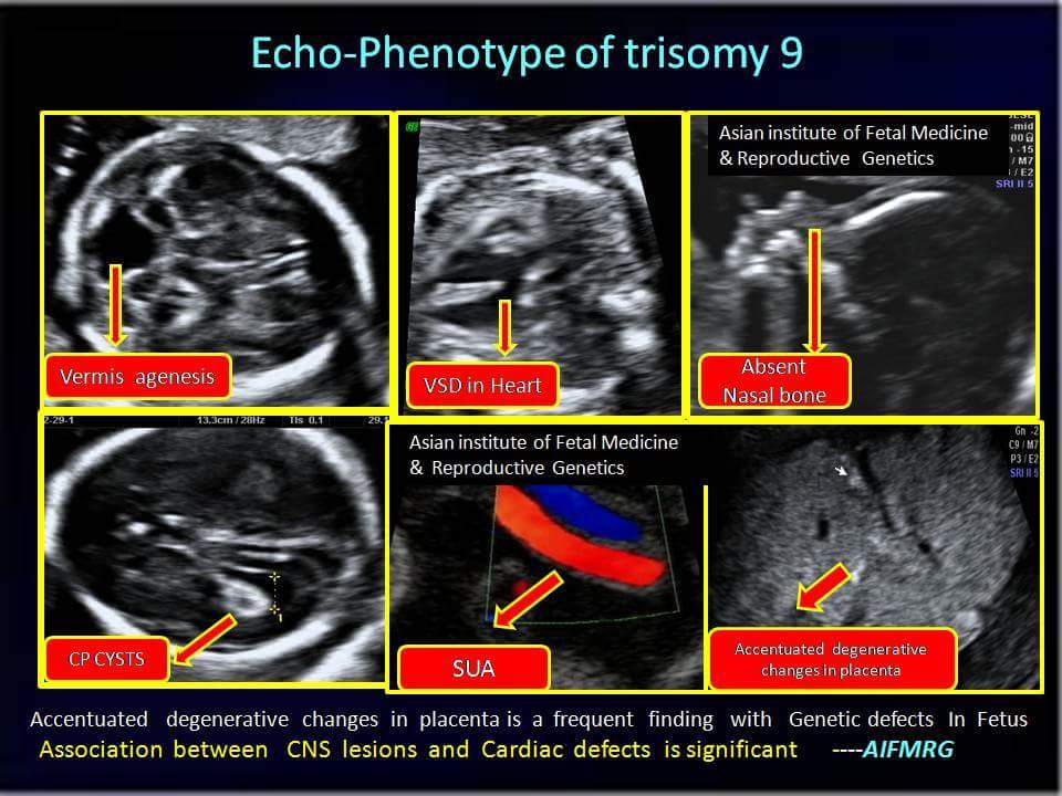 Echo-Phenotype of Trisomy