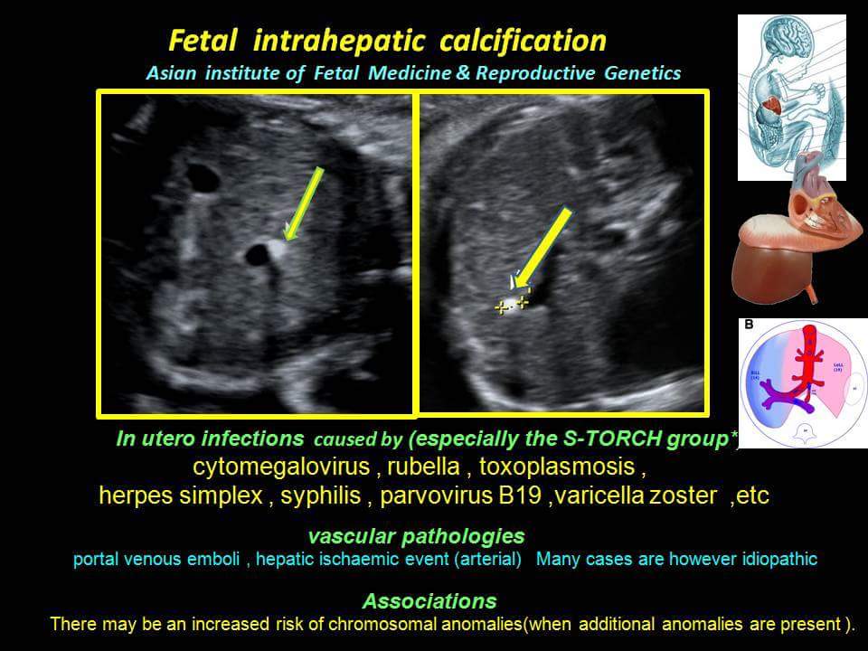 Fetal Intrahepatic Calcification