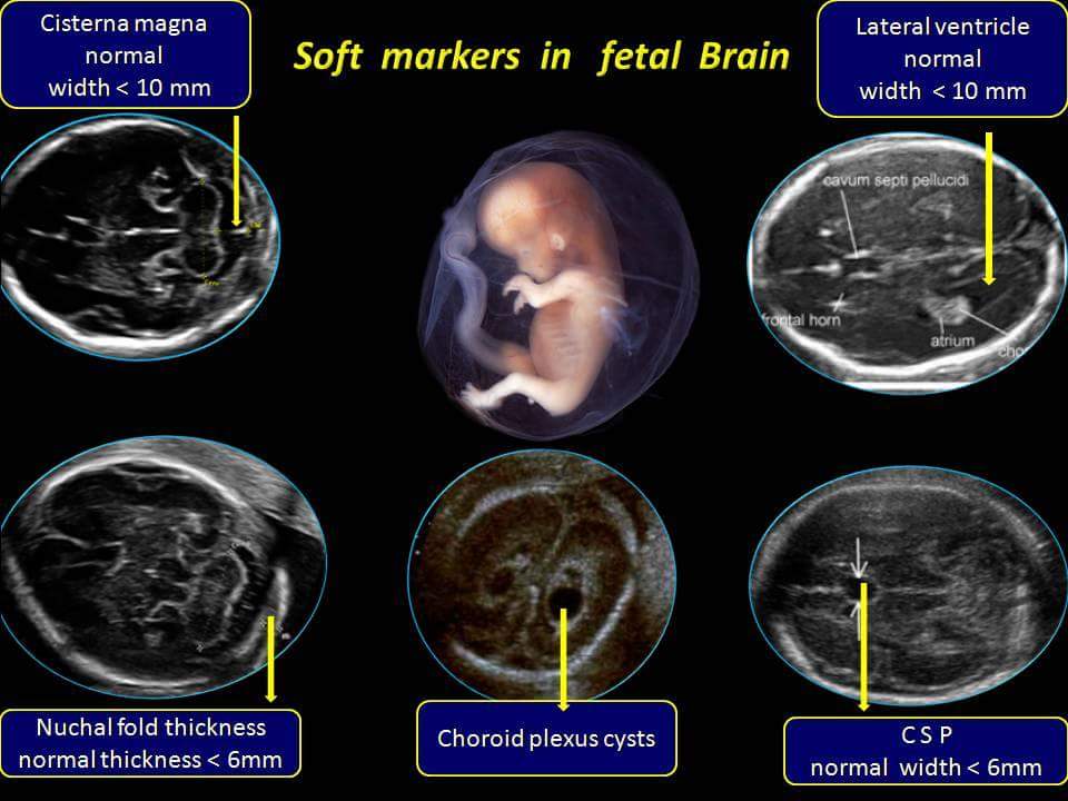 Soft Markers in Fetal Brain