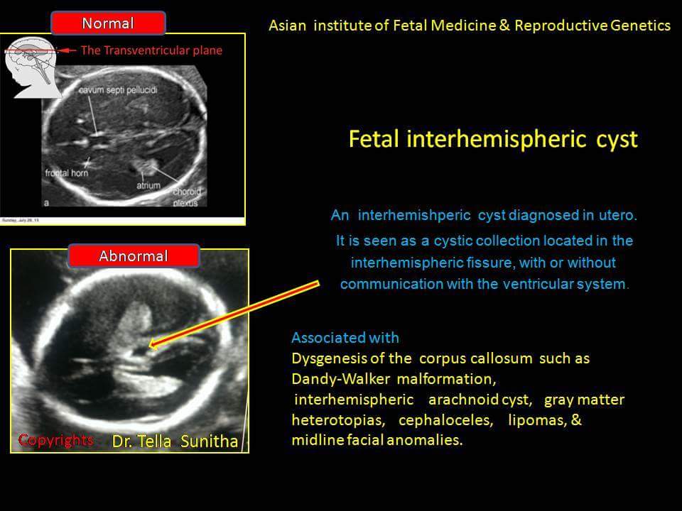 Fetal Interhemispheric Cyst