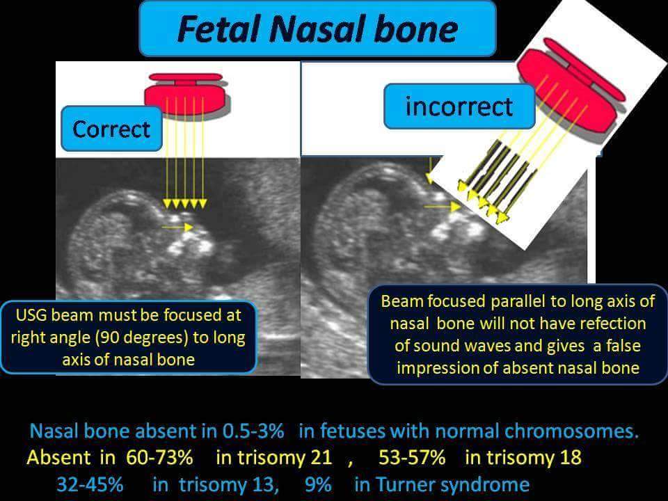 Fetal Nasal Bone